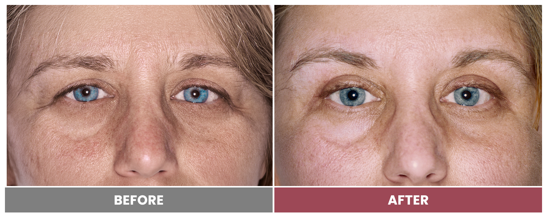 LASER SKIN RESURFACING - Case 8